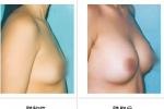 乳腺脂肪瘤 Breast lipoma