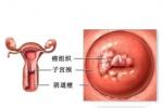 生殖道腫瘤 genital tract tumors
