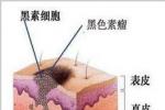 肉瘤皮膚轉移