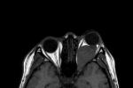 視神經膠質瘤 兒童纖維星形視神經膠質細胞瘤
