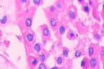腎嗜酸細胞瘤