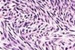 神經纖維肉瘤 M95400 3 