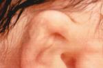 外耳道乳頭狀瘤 D23.251 