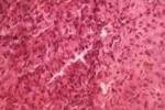 透明細胞軟骨肉瘤