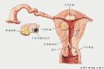 外陰腫瘤合並妊娠 外陰腫瘤並妊娠