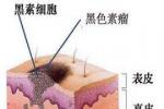 外陰黑色素瘤 外陰黑素瘤