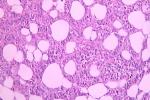 小兒生殖細胞瘤 小兒生殖細胞性腫瘤小兒胚組織瘤