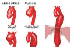 胸降主動脈動脈瘤