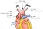 胸降主動脈動脈瘤