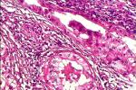 腺泡細胞癌 M85500 3 漿液細胞腺癌