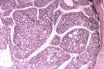腺樣囊性癌 M82000 3 圓柱瘤圓柱瘤型腺癌 囊性腺樣癌