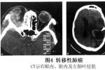 眼眶轉移性腫瘤