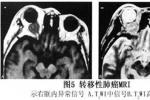 眼眶轉移性腫瘤