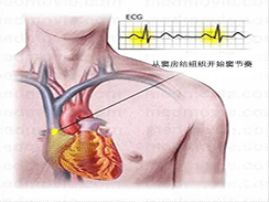 心肌炎 I51.403 