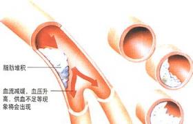 高脂血癥 E78.501 