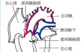 房間隔缺損