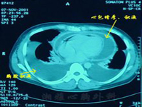心包炎 I31.907 