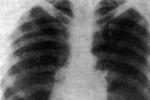 原發性肺動脈高壓