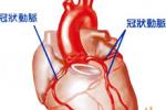 冠狀動脈起源異常
