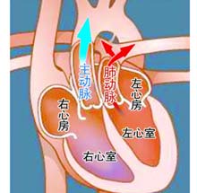 大動脈錯位