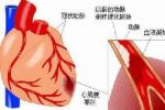 心室顫動 特發性室顫 特發性心室纖維性顫動