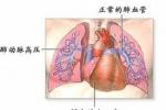 急性左心功能衰竭 老年人發作性室上性心動過速