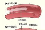 胃動脈硬化 動脈粥樣硬化