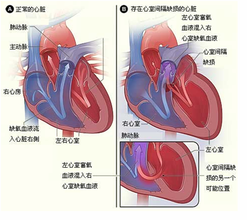 心房內折返性心動過速