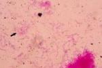 銅綠假單胞菌感染