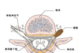 痙攣性截癱