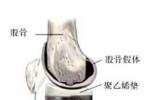 風濕性關節炎 I00.X03 急性風濕性關節炎