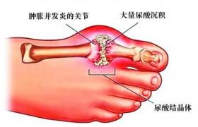 高尿酸血癥 E79.001 痛風