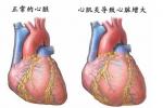 風濕熱 I00.X02 急性風濕病 急性風濕性多關節炎