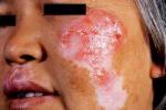 皮肌炎 M33.101 皮膚異色性皮肌炎 DM poikilodermatomyositis dermatomyositis