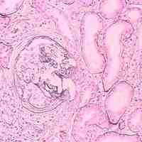 狼瘡腎炎 狼瘡性腎炎 系統性紅斑狼瘡性腎炎