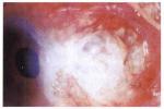 韋格納肉芽腫 M31.301 韋格內肉芽腫 韋格納肉芽腫病 壞死性肉芽腫