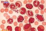 慢性粒細胞白血病