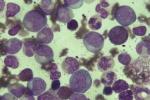 慢性粒細胞白血病