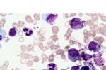 單核細胞白血病 單核細胞性白血病