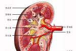 急性腎炎 N00.902 急性腎小球腎炎 急性感染後腎小球腎炎 急性鏈球菌感染後腎