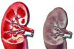 腎功能不全 N19.X02 腎功能衰竭 腎輸尿管絞痛