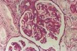 膜性腎病 N05.201 膜性腎小球腎炎 膜性腎小球性腎炎