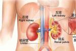 腎下垂 N28.813 kidney ptosis