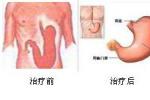 腎下垂 N28.813 kidney ptosis