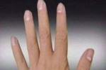 指甲-髕骨綜合征 甲髕綜合征 遺傳性甲骨萎縮病 指甲髕骨綜合