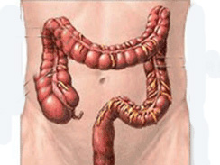 潰瘍性結腸炎 ulcerative colitis UC 慢性非特異性潰瘍性結腸炎