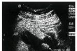 消化道潰瘍 胃十二指腸球部潰瘍 消化性潰瘍