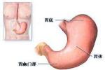 胃瀦留 K31.826 胃排空延遲