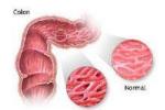 細菌性腸炎 Bacterial enteritis