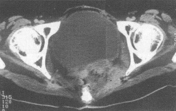 放射性腸炎 K52.001 